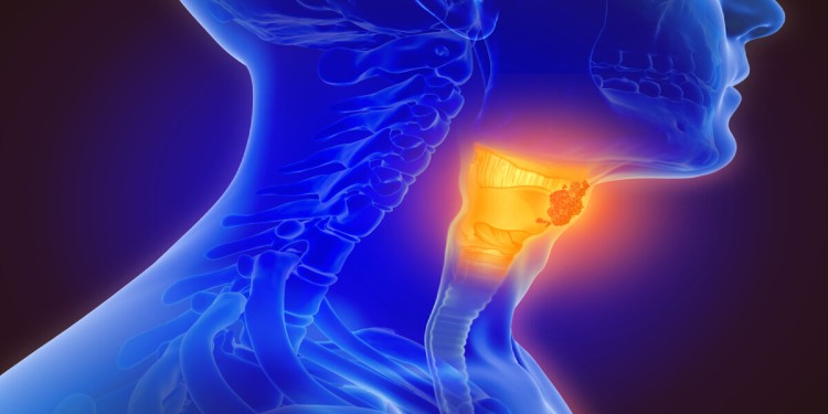 Throat Cancer